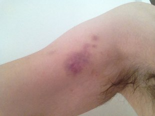 Bruise