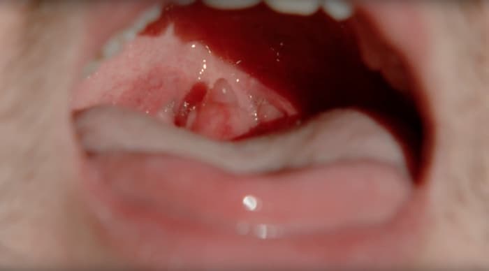 uvula - oral sex and cancer