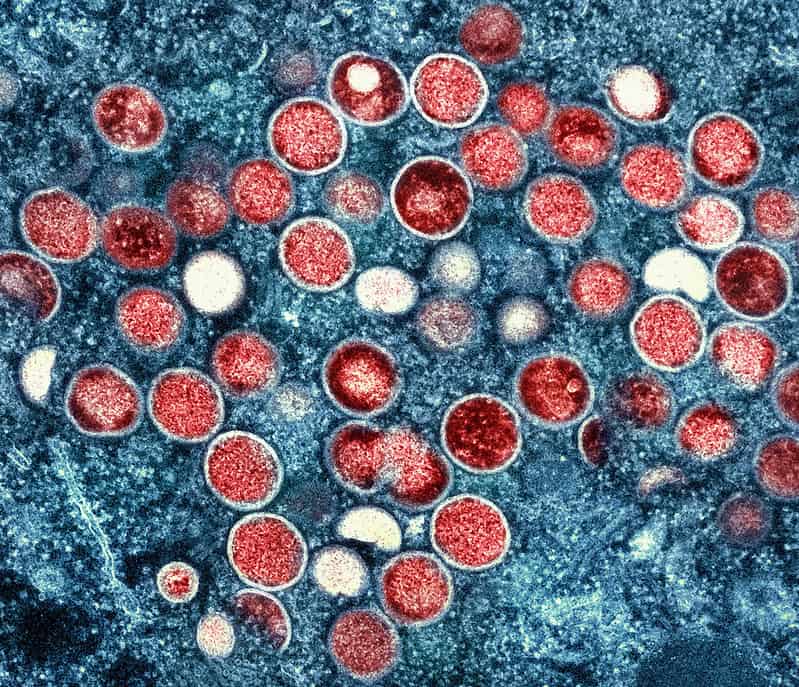 monkeypox symptoms transmission