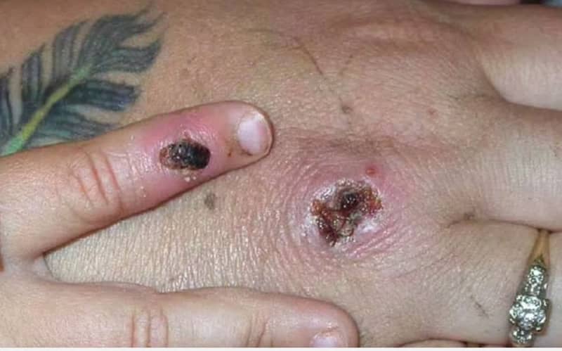 Monkeypox Is Spreading Through Sex: Is It An Std? Here’s What To Know 1 587703 origin 1