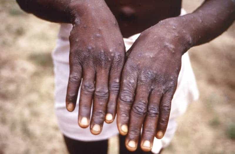 U.s. Cdc Confirms Evidence Of Local Monkeypox Transmission; Who Considers Declaring Monkeypox A Global Health Emergency 2 587713 origin 1