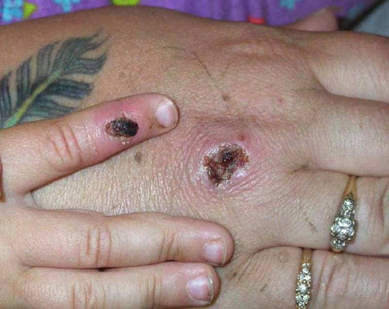 Monkeypox cases in NYC double in a week, health officials say 19 593258 origin 1