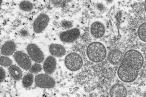 Monkeypox is on the rise. Here's what to know about its symptoms 4 594494 origin 1
