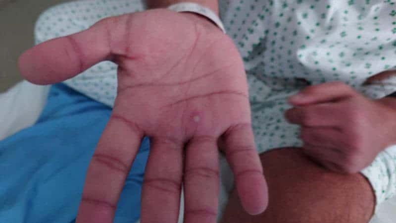 Analysis-Years of neglect leaves sexual health clinics ill-prepared for monkeypox 21 599212 599212 origin 1 1