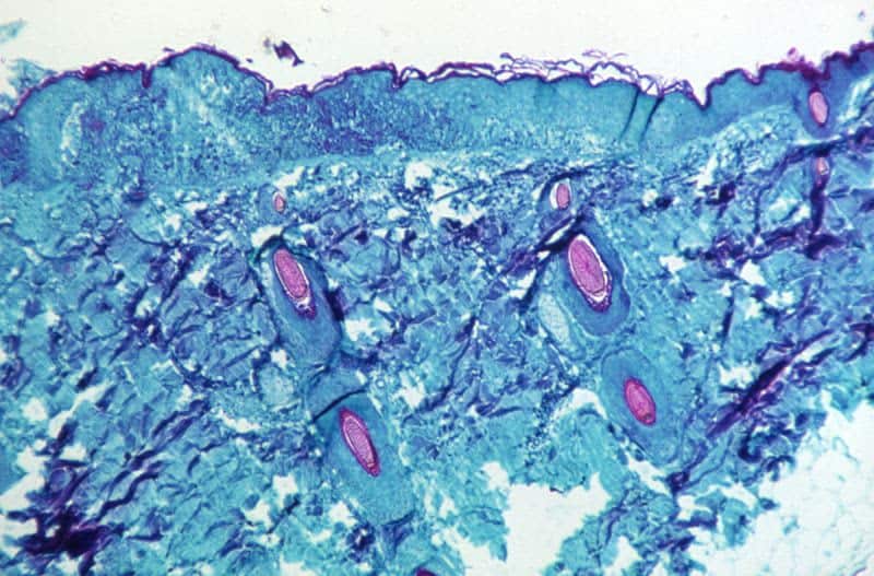 U.S. identifies first cases of monkeypox in children 49 603047 603047 origin 1 1