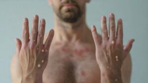 Mpox, Poxy McPoxface and TRUMP-22: Public sends WHO suggestions to rename monkeypox 22 637319 origin 1