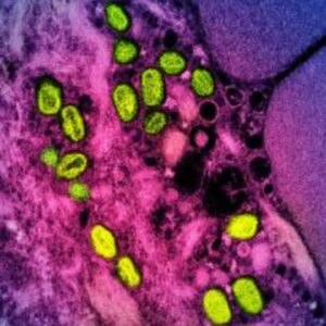 Second US monkeypox death as virus linked to brain inflammation 50 642651 origin 1