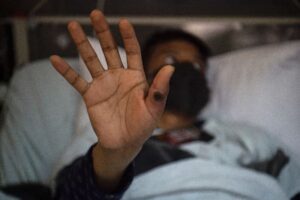 WHO declares mpox no longer a global health emergency 8 678176 origin 1